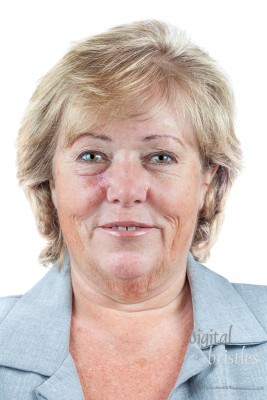 Mature woman with healing scar two weeks after Mohs surgery for Basal Cell Carcinoma